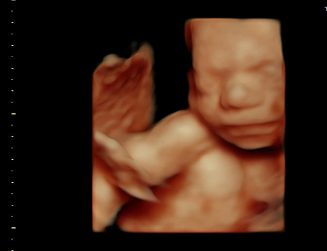 3D ultrasound image at 25 weeks